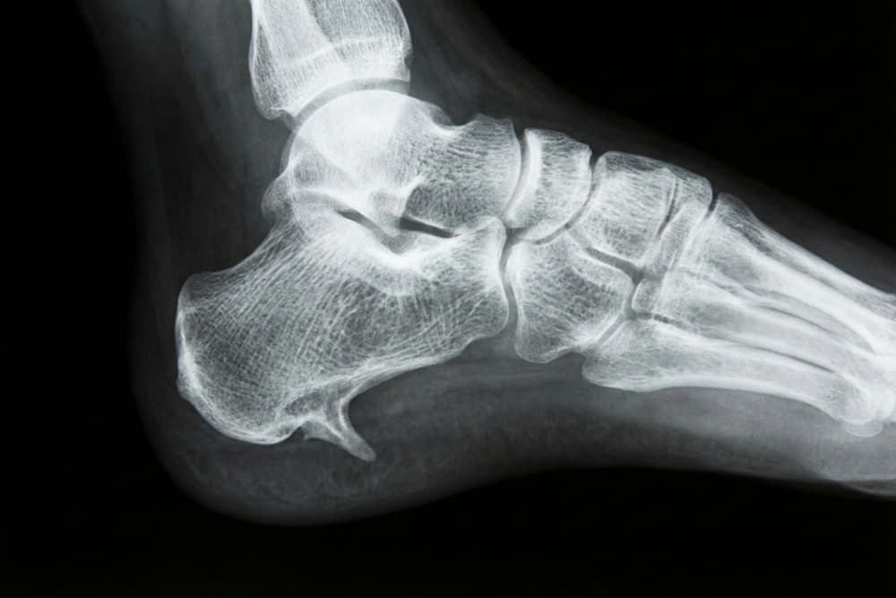 Et røntgenbillede af foden set i profil, der tydeligt viser en spids knogleudvækst på undersiden af hælknoglen. Denne calcaneusspore illustrerer en almindelig årsag til hælsmerter, der ofte opstår i forbindelse med langvarig overbelastning af plantar fascia-senen.